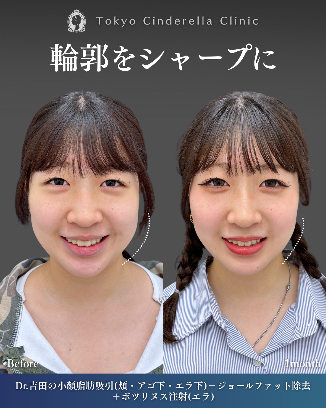 輪郭をシャープに、二重顎も解消 」に関する美容整形の症例写真の詳細