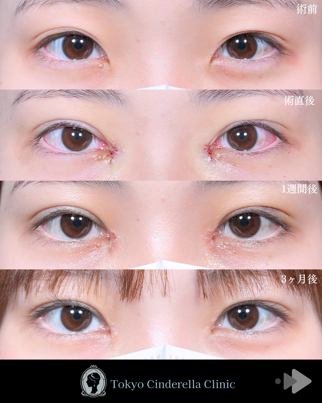 二重幅7mm 」に関する美容整形の症例写真の詳細 | 新宿・池袋・大宮