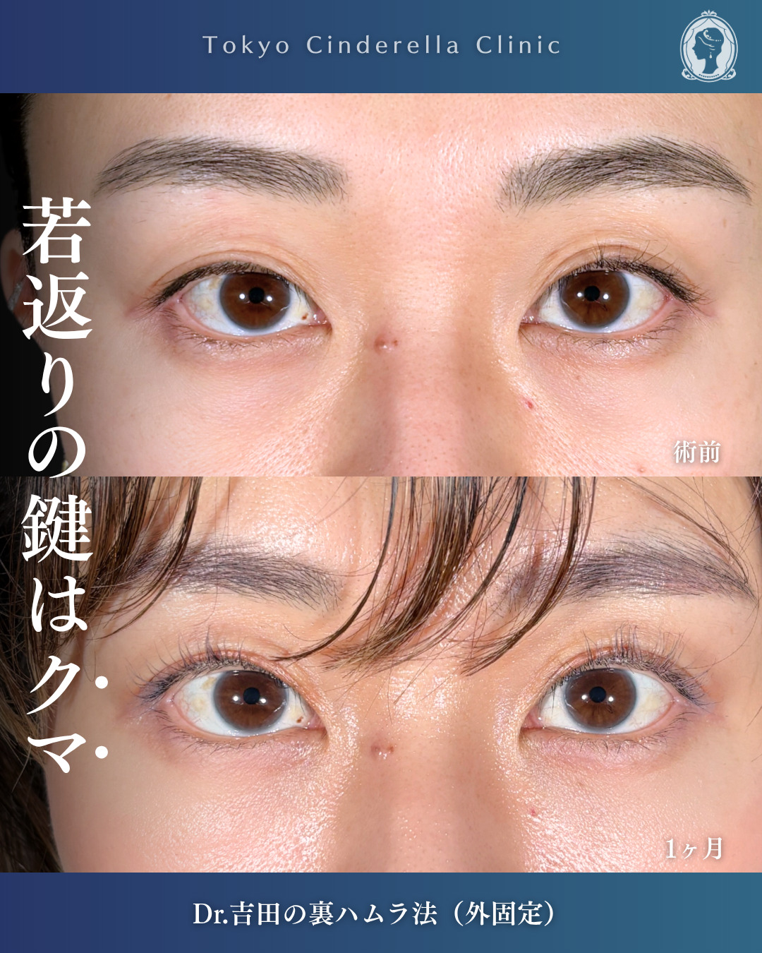 横浜院で行ったクマ取りの名医の吉田利之医師の裏ハムラ法の1ヶ月後の症例写真