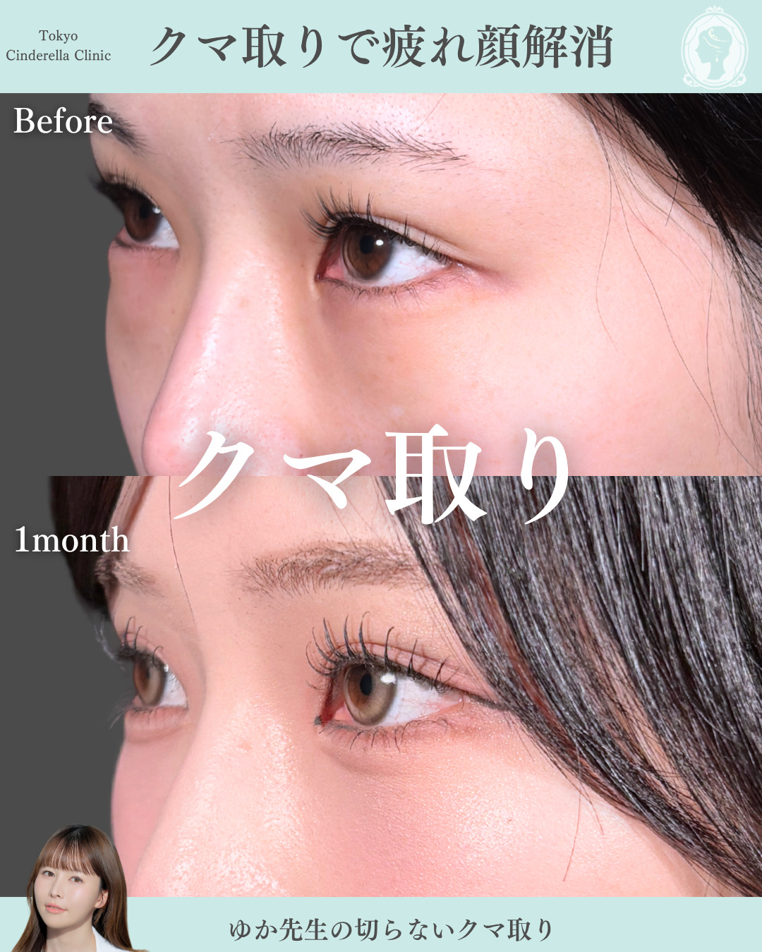 二重幅7mm 」に関する美容整形の症例写真の詳細 | 新宿・池袋・大宮