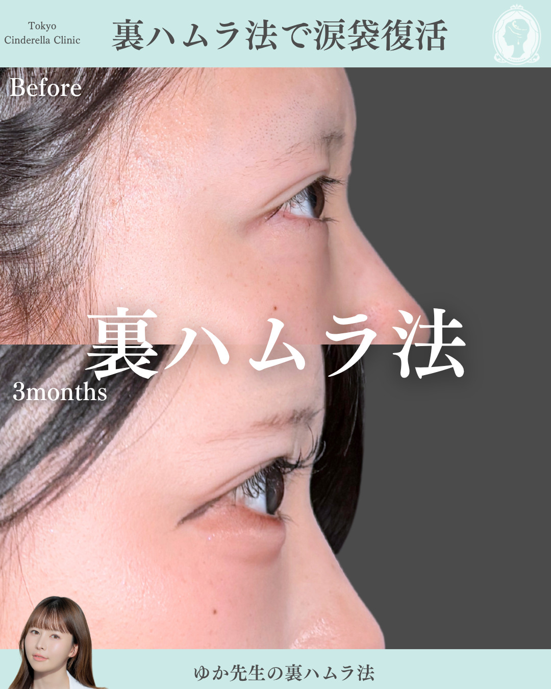 新宿院で行った裏ハムラ法で有名な宮﨑友伽医師の症例写真