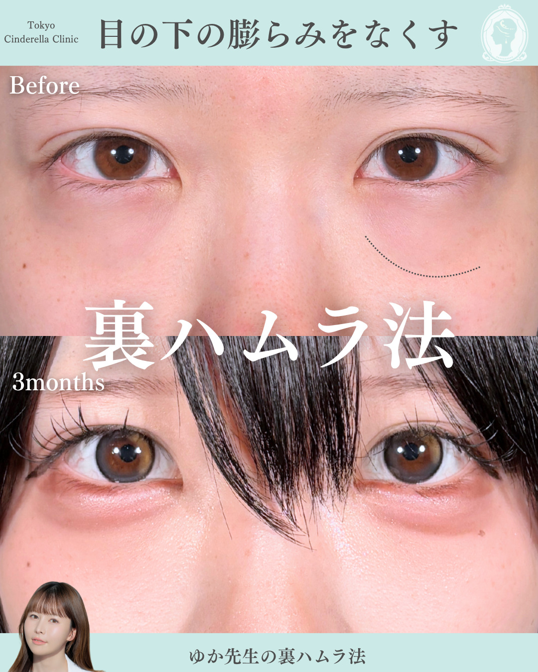 新宿院で行った裏ハムラ法で有名な宮﨑友伽医師の症例写真