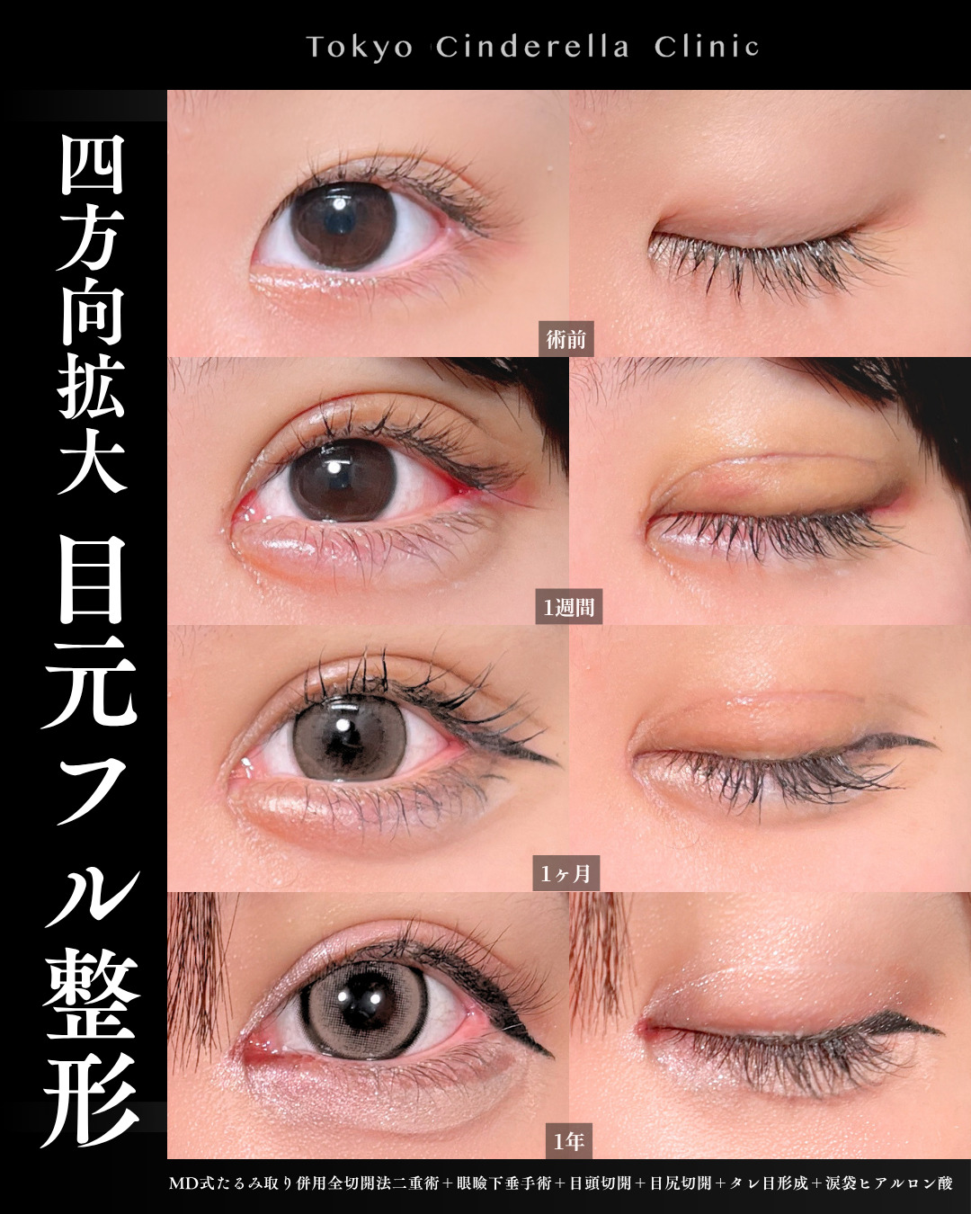 眼瞼下垂は何科で受けるべき？医師が解説｜美容整形は東京シンデレラ