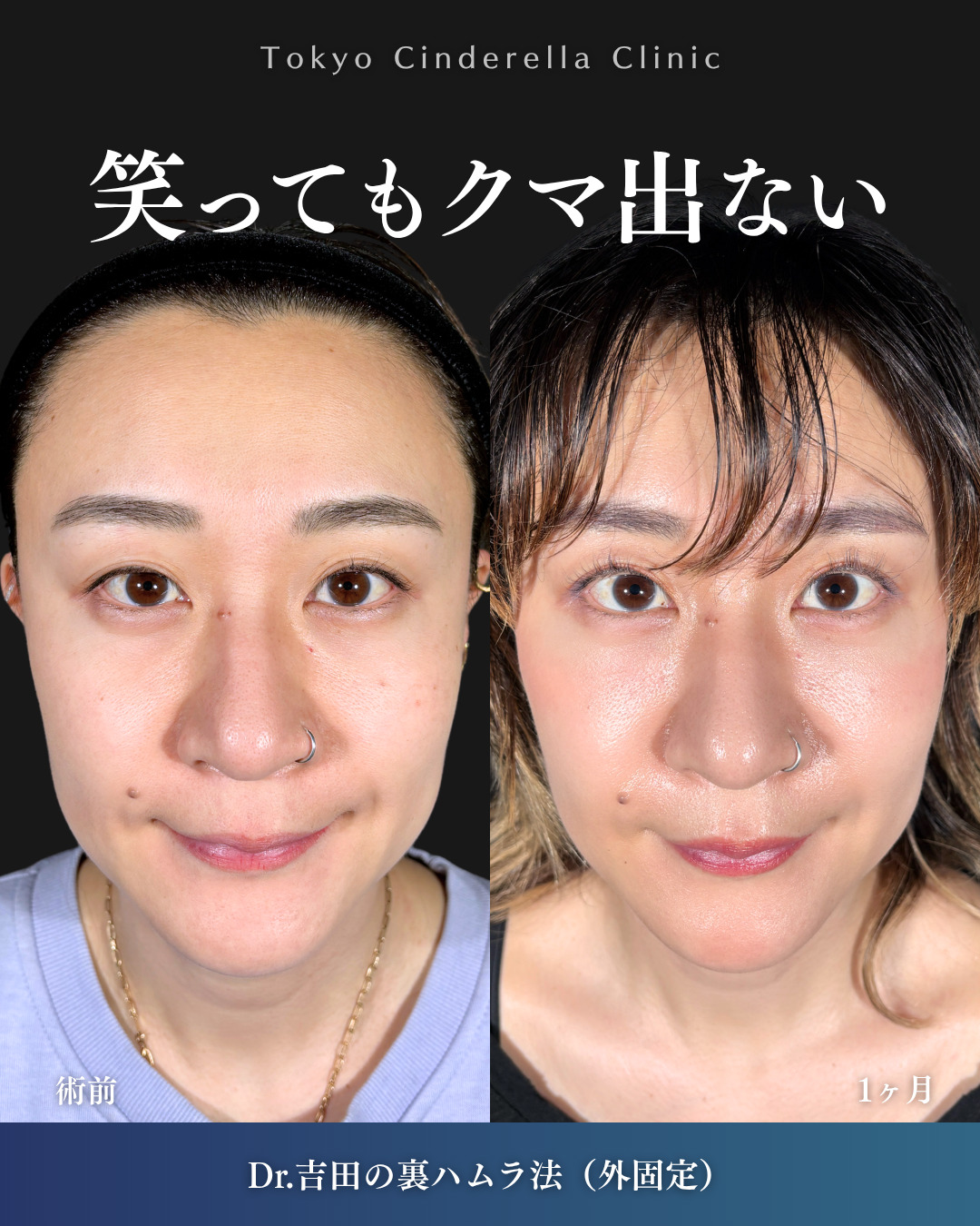横浜院で行ったクマ取りの名医の吉田利之医師の裏ハムラ法の1ヶ月後の症例写真