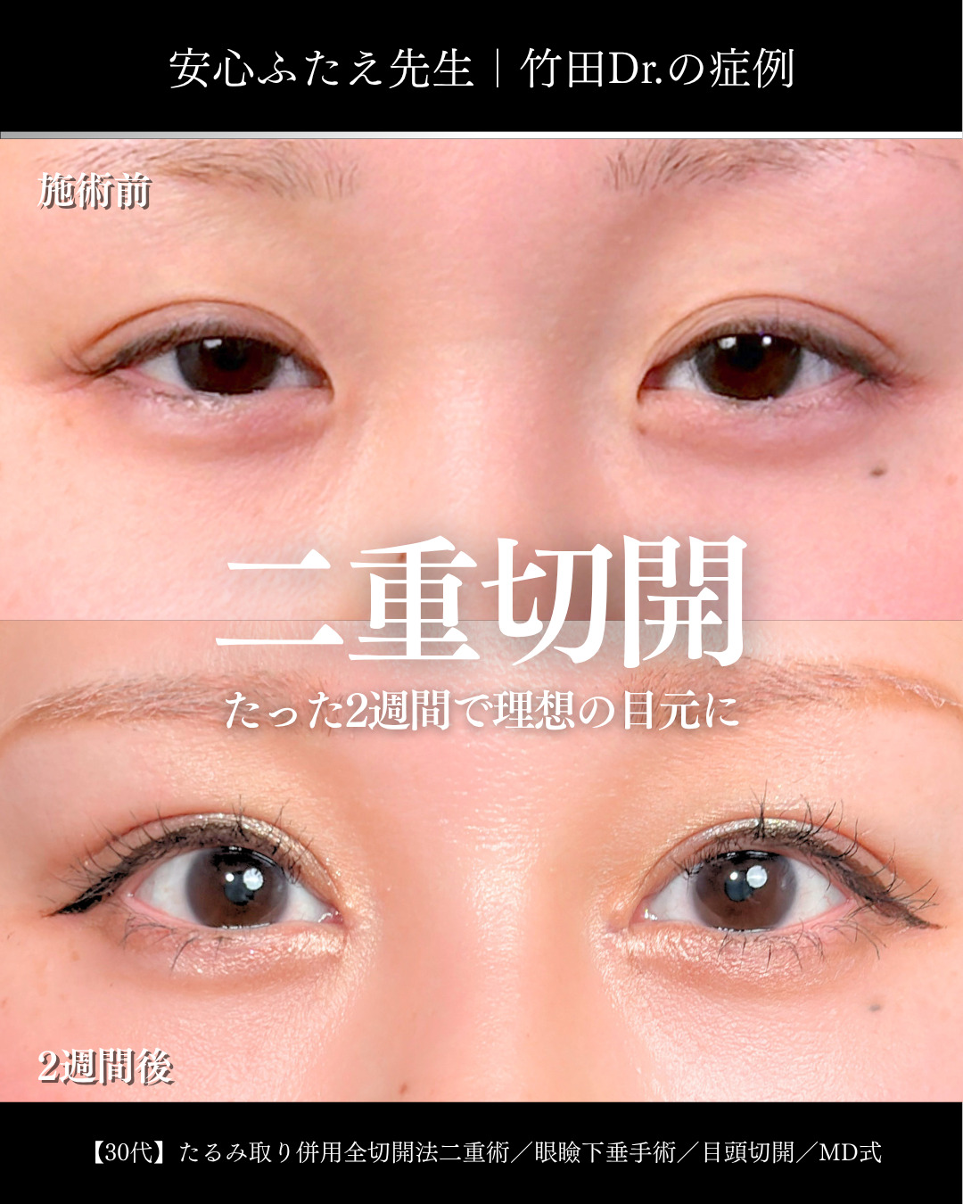 二重幅9mm 」に関する美容整形の症例写真の詳細 | 新宿・池袋・大宮