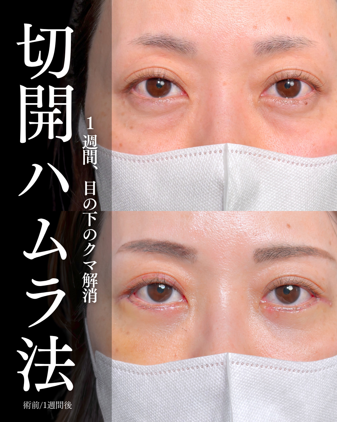 大宮院で行った切開ハムラ法で有名な名医の竹田昌平医師の症例写真
