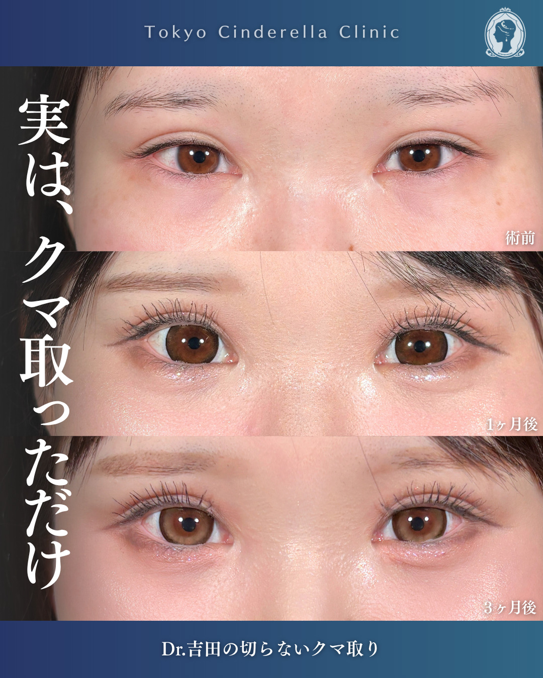 横浜院で行ったクマ取りの名医の吉田利之医師の切らないクマ取りの3ヶ月後までのダウンタイム症例写真