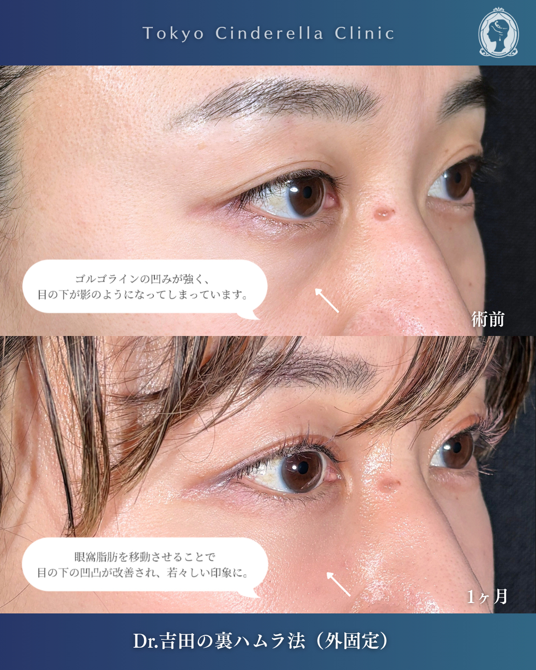 横浜院で行ったクマ取りの名医の吉田利之医師の裏ハムラ法の1ヶ月後の症例写真