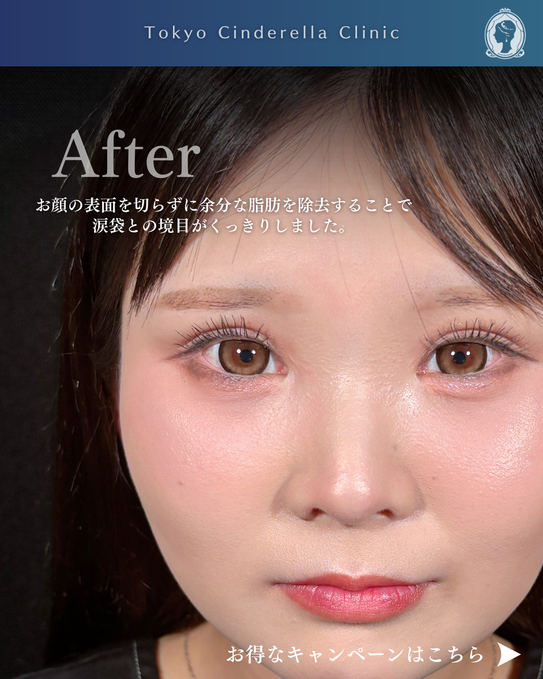 二重幅7mm 」に関する美容整形の症例写真の詳細 | 新宿・池袋・大宮