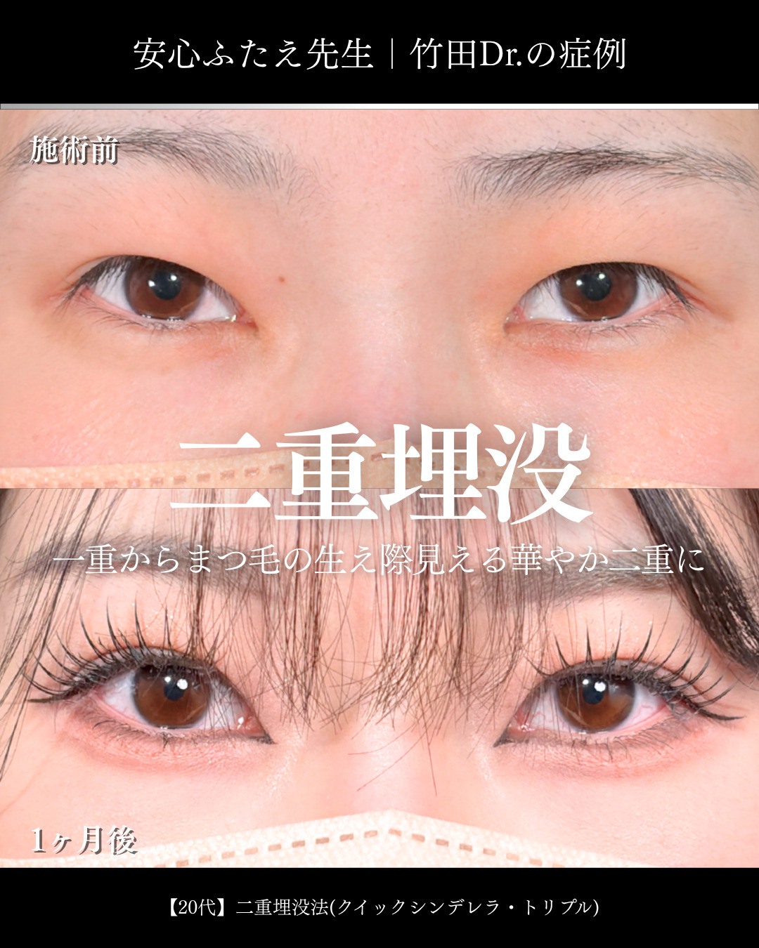 大宮院で行った二重埋没で有名な名医の竹田昌平医師の症例写真