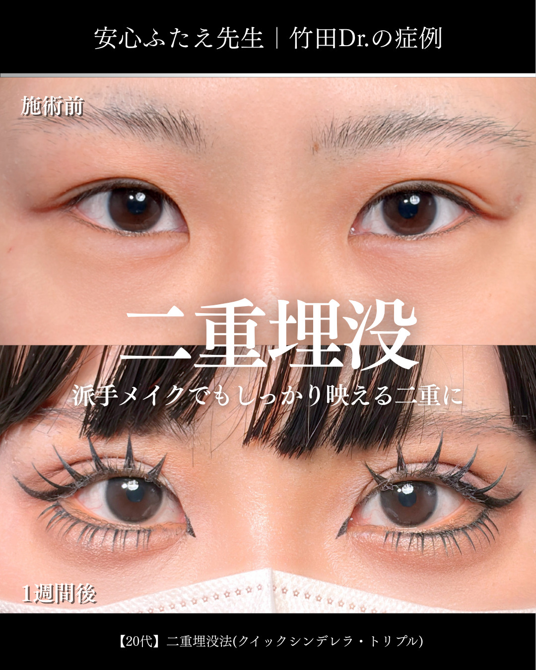 派手メイク負けしない二重 」に関する美容整形の症例写真の詳細 | 新宿