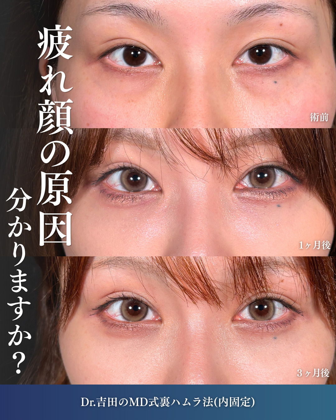 横浜院で行ったクマ取りの名医の吉田利之医師のMD式裏ハムラ法の3ヶ月後までのダウンタイム症例写真