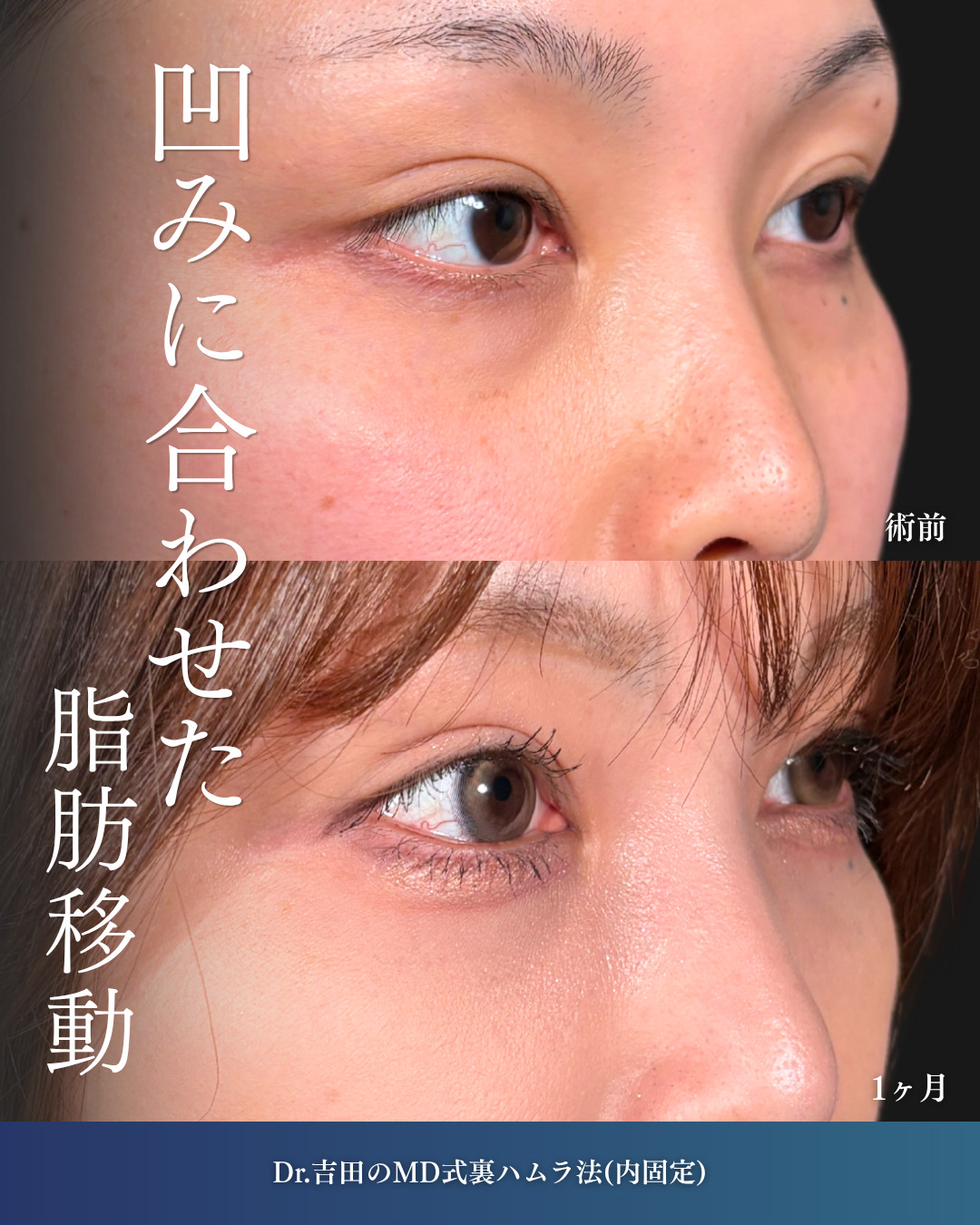 横浜院で行ったクマ取りの名医の吉田利之医師のMD式裏ハムラ法の3ヶ月後までのダウンタイム症例写真