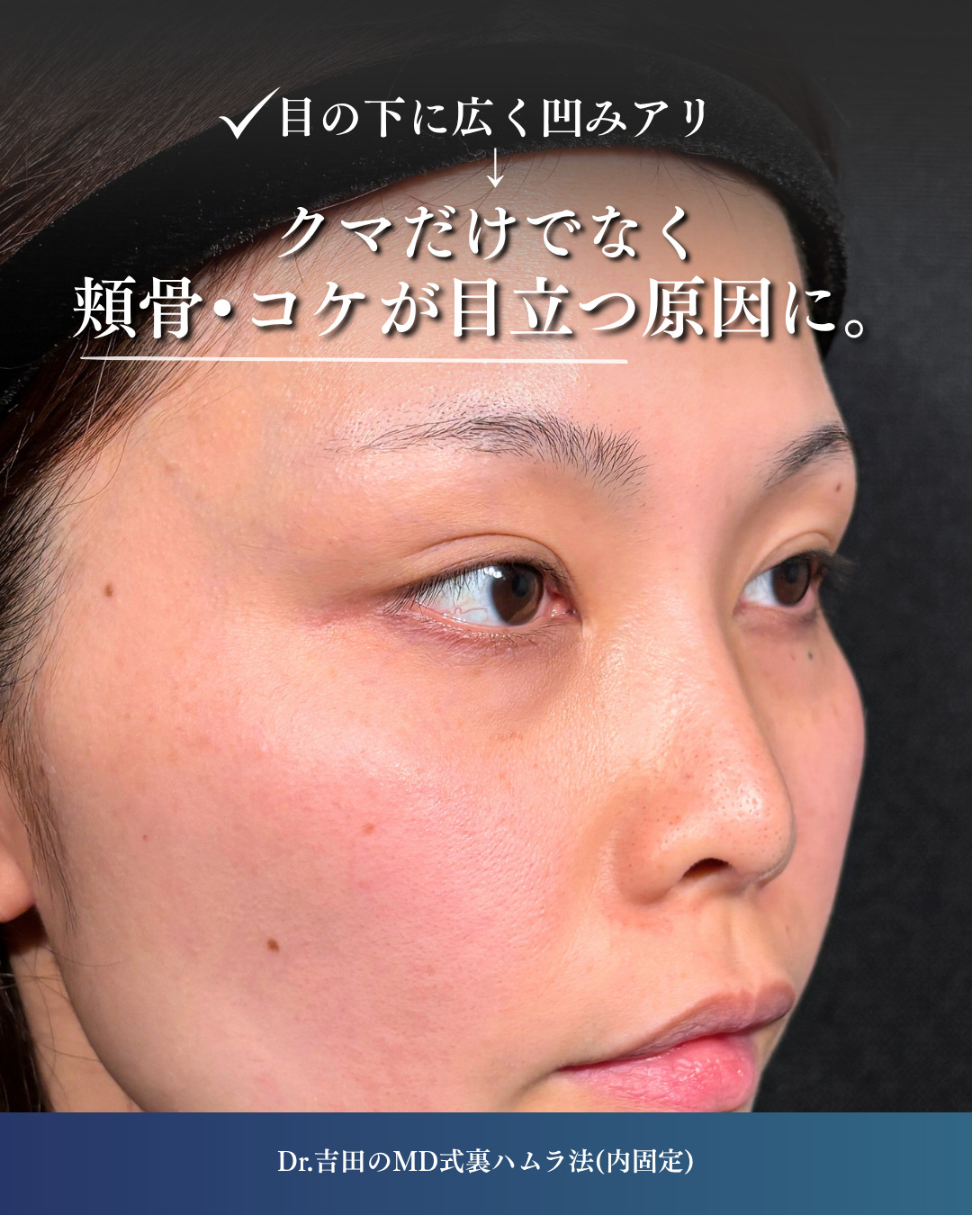 横浜院で行ったクマ取りの名医の吉田利之医師のMD式裏ハムラ法の3ヶ月後までのダウンタイム症例写真