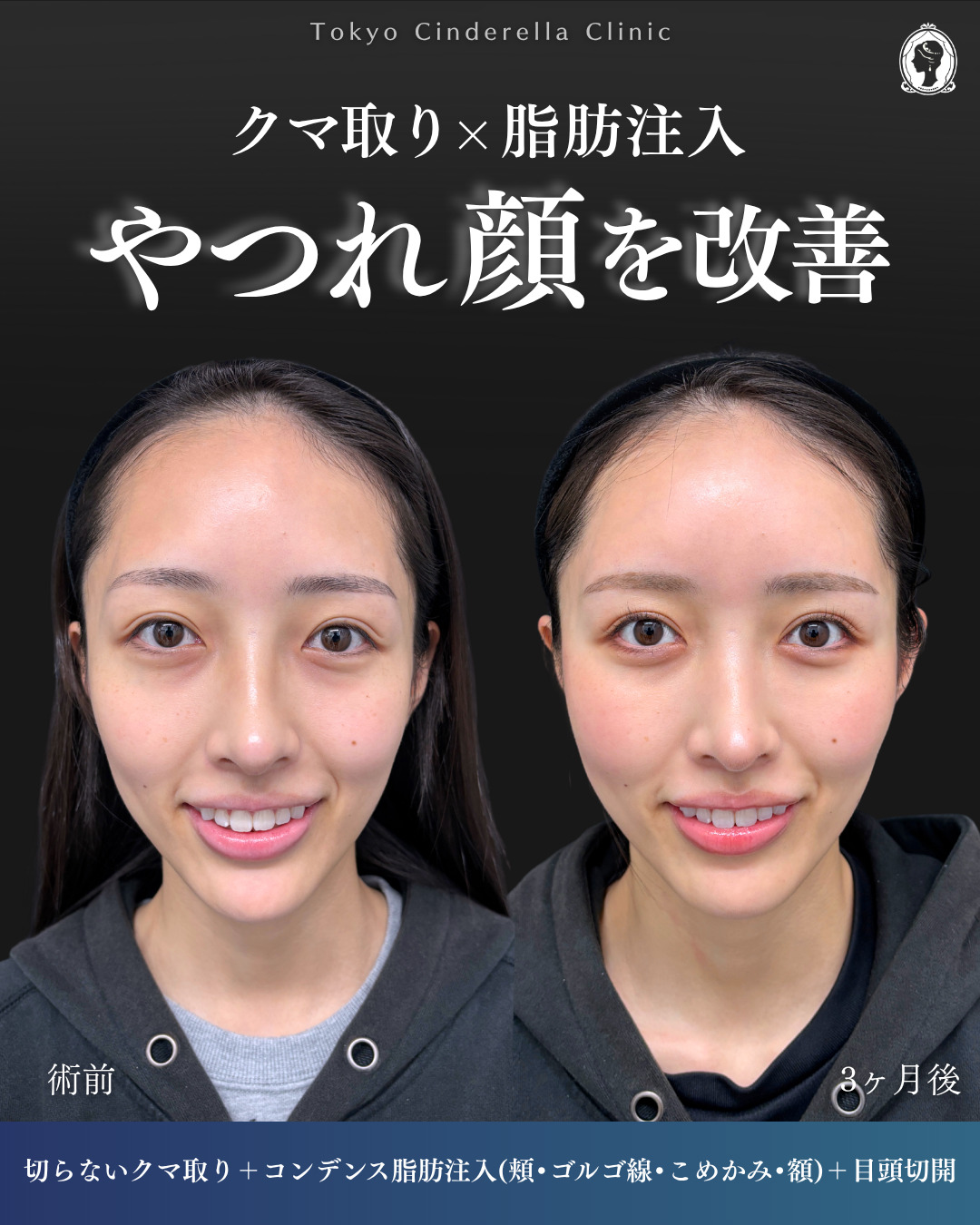 横浜院で行ったクマ取りの名医の吉田利之医師の切らないクマ取りと顔の脂肪注入の3ヶ月後までのダウンタイム症例写真