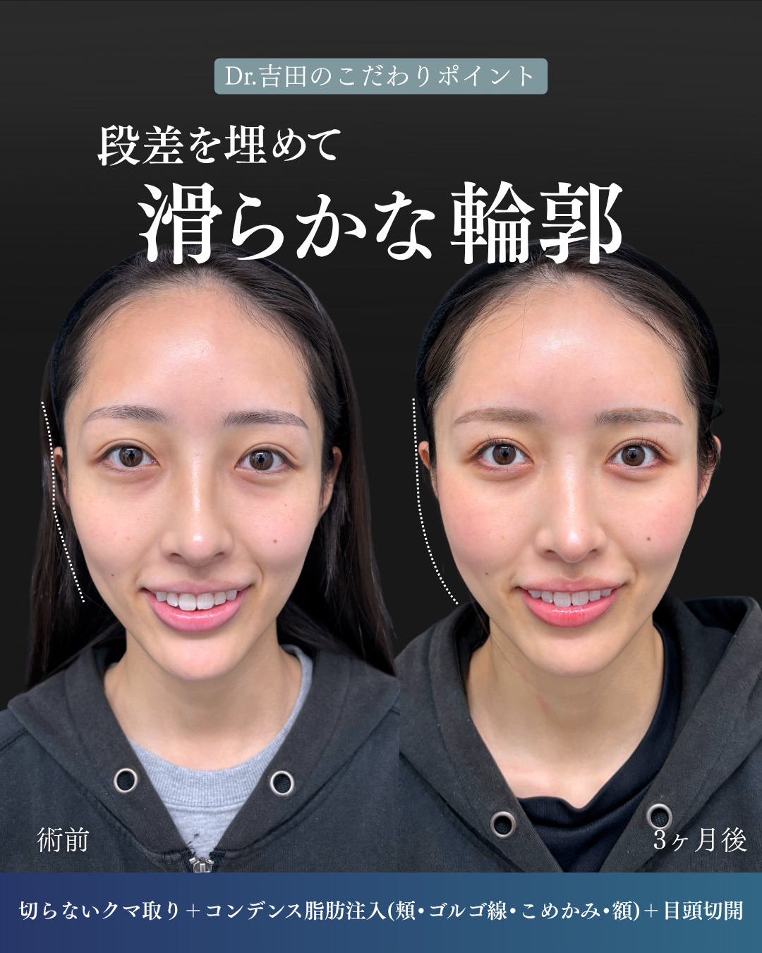 横浜院で行ったクマ取りの名医の吉田利之医師の切らないクマ取りと顔の脂肪注入の3ヶ月後までのダウンタイム症例写真