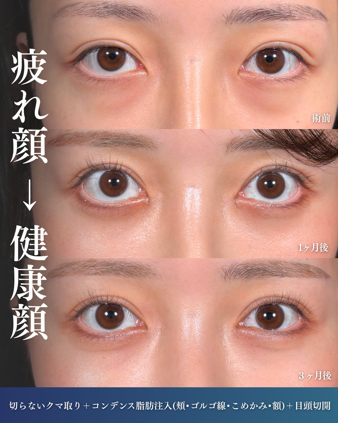 横浜院で行ったクマ取りの名医の吉田利之医師の切らないクマ取りと顔の脂肪注入の3ヶ月後までのダウンタイム症例写真