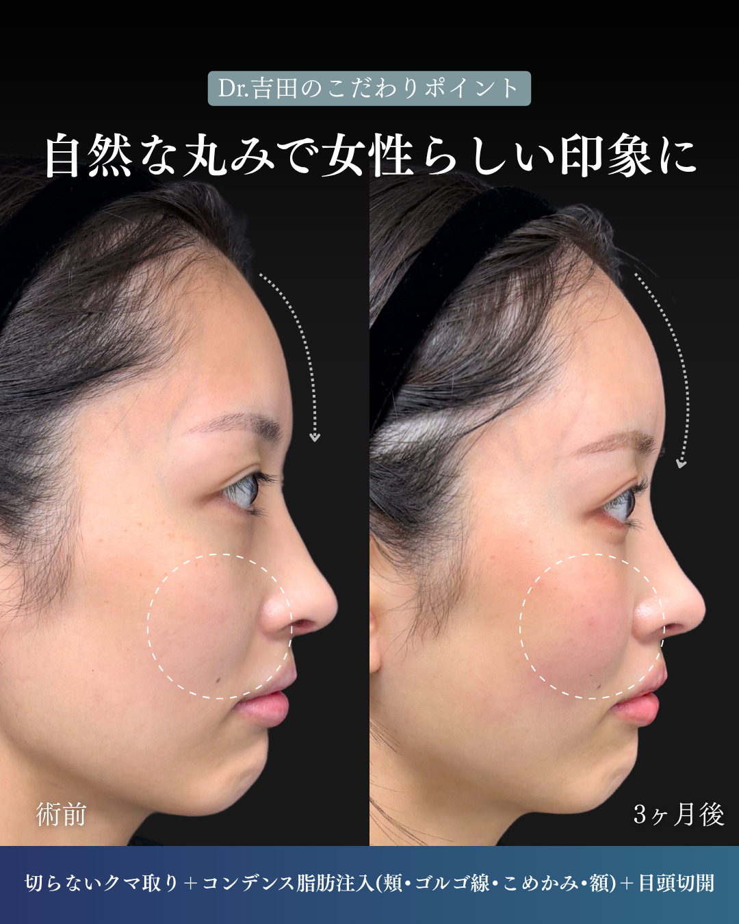 横浜院で行ったクマ取りの名医の吉田利之医師の切らないクマ取りと顔の脂肪注入の3ヶ月後までのダウンタイム症例写真