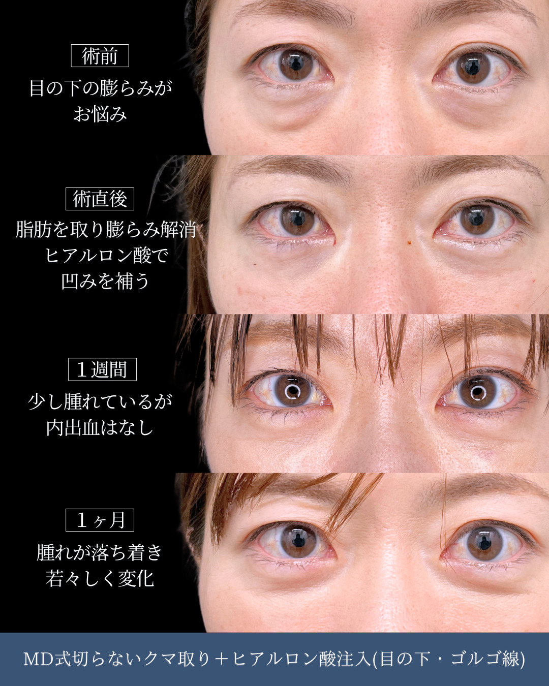 新宿院院長吉原伯執刀、切らないクマ取りとヒアルロン酸注入の１ヶ月ダウンタイム比較