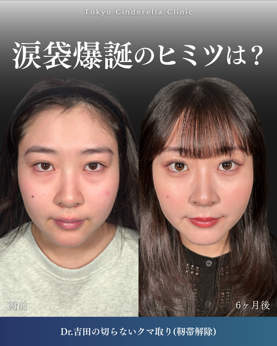 横浜院で行ったクマ取りの名医の吉田利之医師の切らないクマ取りの6ヶ月後までのダウンタイム症例写真
