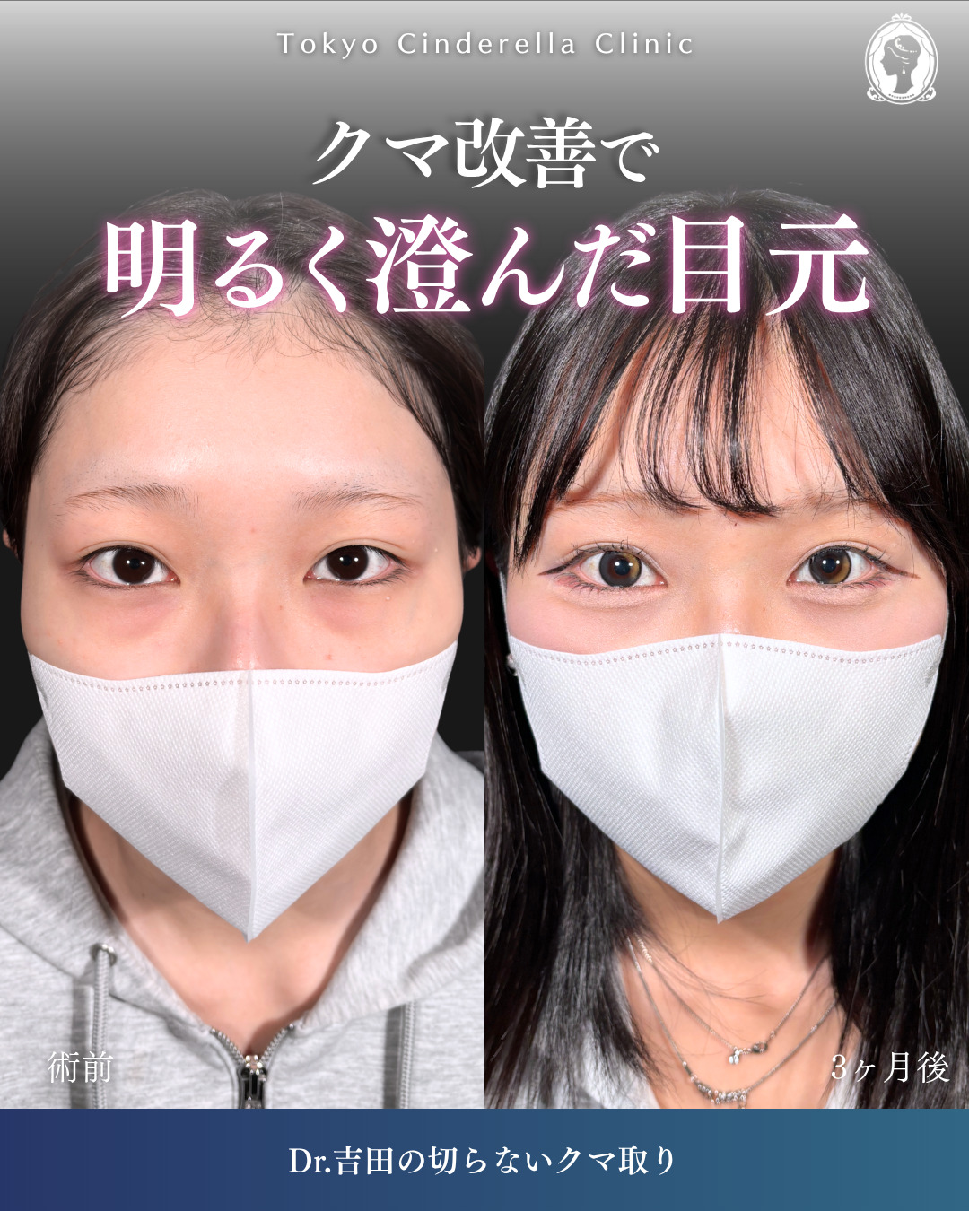 横浜院で行ったクマ取りの名医の吉田利之医師の切らないクマ取りの3ヶ月後までのダウンタイム症例写真