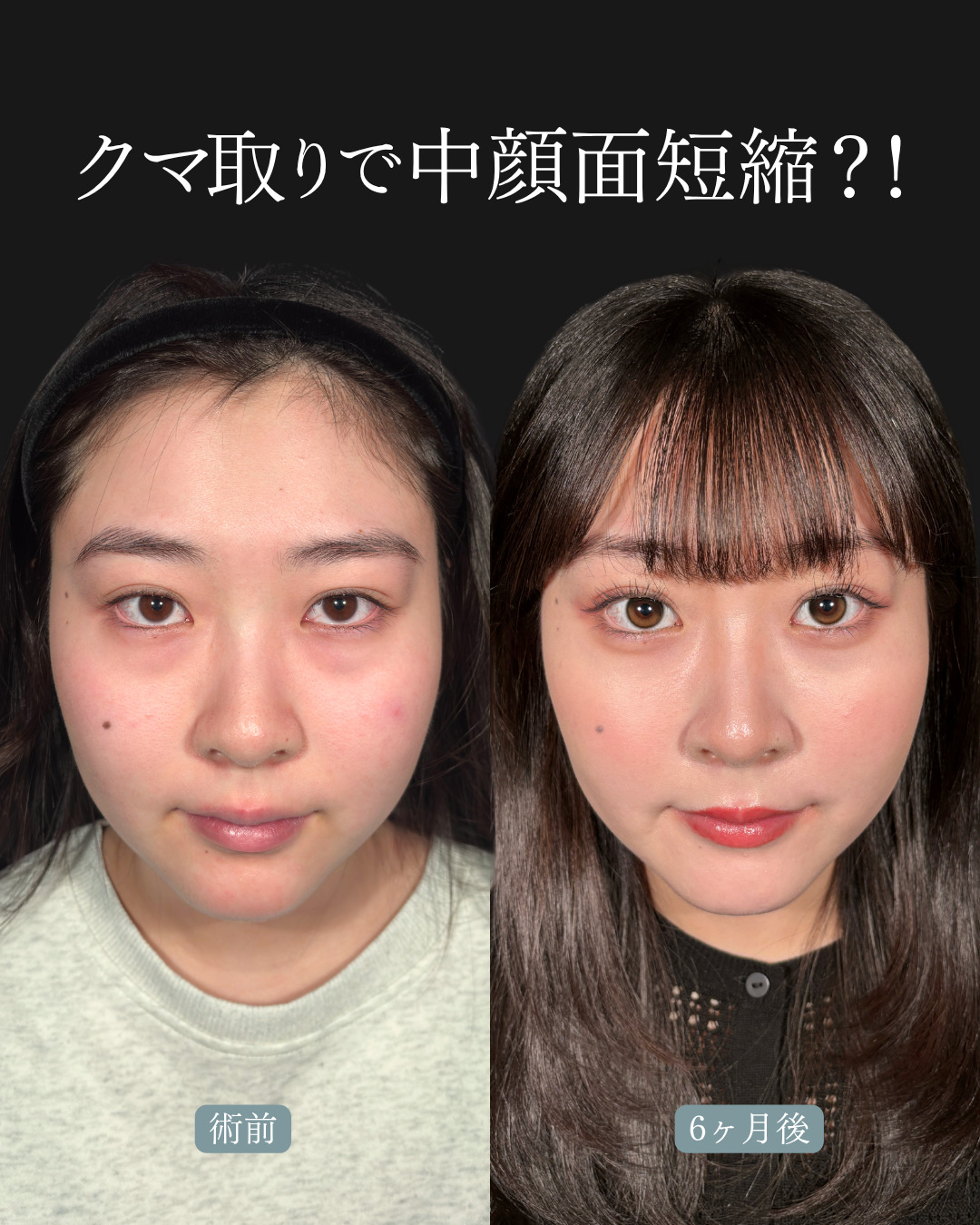 横浜院で行ったクマ取りの名医の吉田利之医師の切らないクマ取りの6ヶ月後までのダウンタイム症例写真
