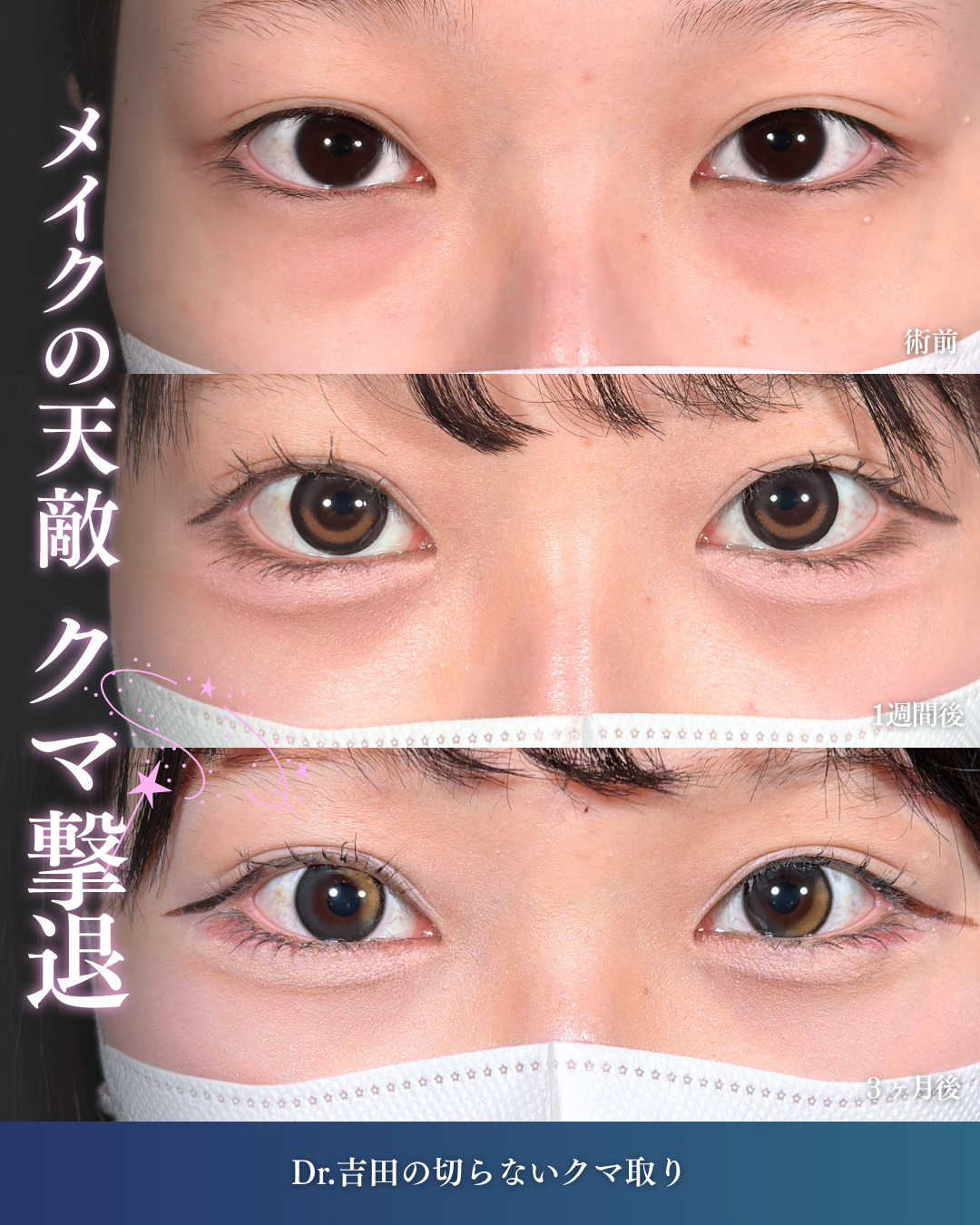 横浜院で行ったクマ取りの名医の吉田利之医師の切らないクマ取りの3ヶ月後までのダウンタイム症例写真