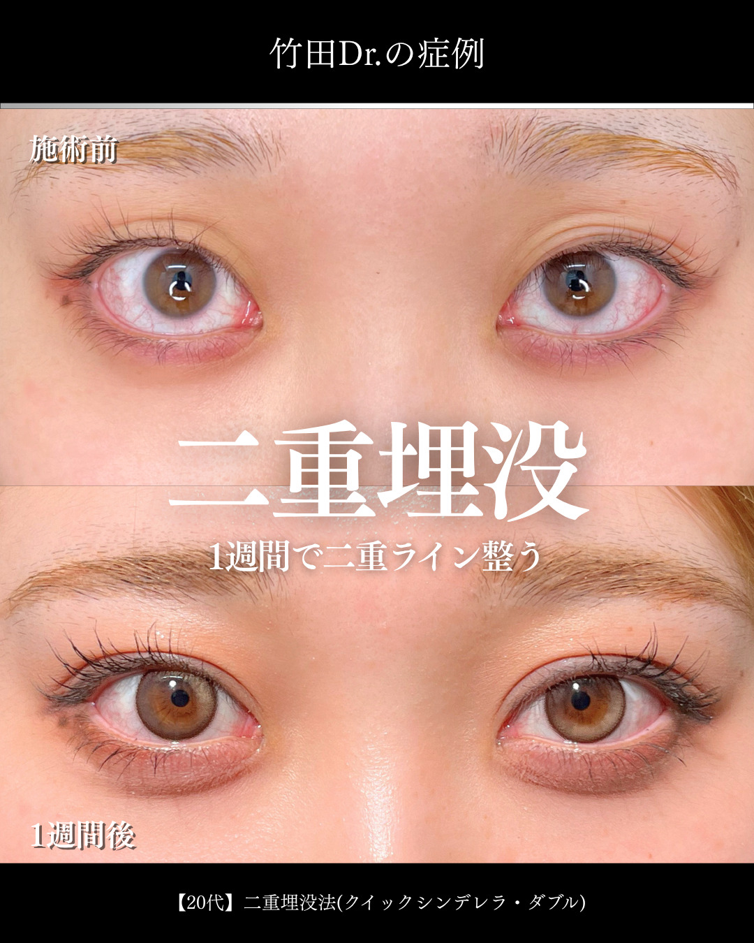 大宮院で行った二重埋没で有名な名医の竹田昌平医師の症例写真
