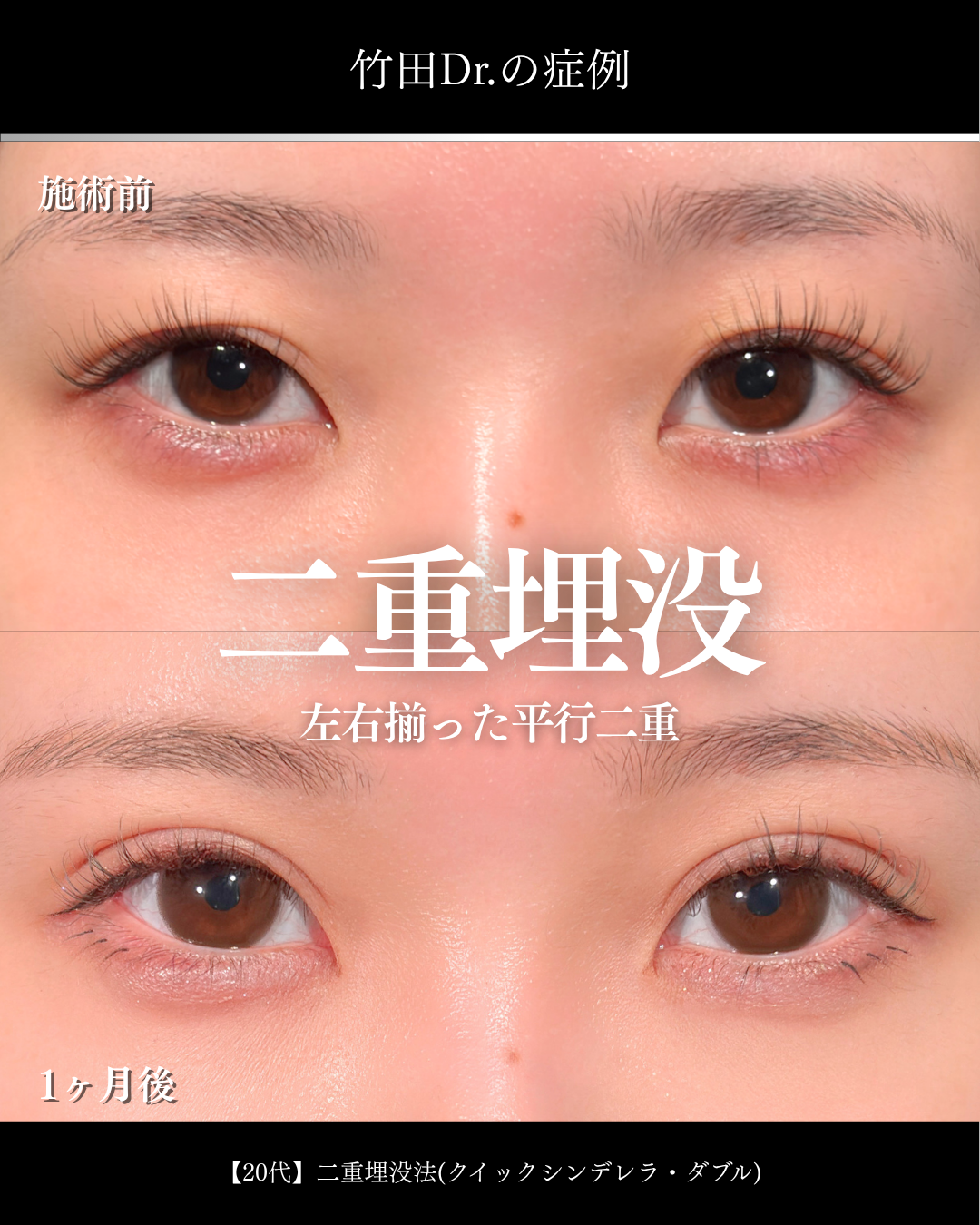 EYEeyelid surgeryセレクト美容塾・眼瞼　美容外科形成外科 デカ目コンタクトでも映える二重 」に関する美容整形の症例写真の詳細