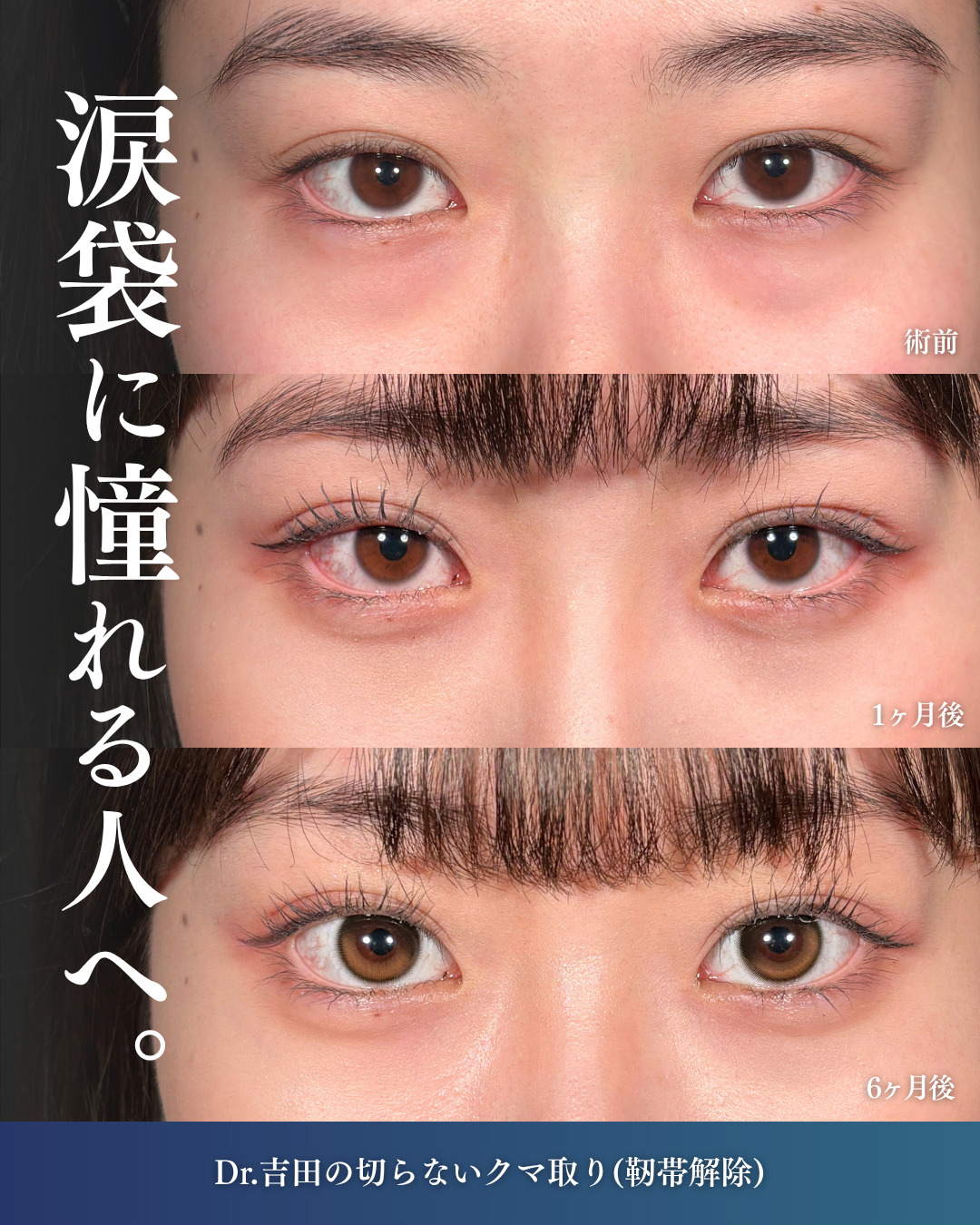 横浜院で行ったクマ取りの名医の吉田利之医師の切らないクマ取りの6ヶ月後までのダウンタイム症例写真