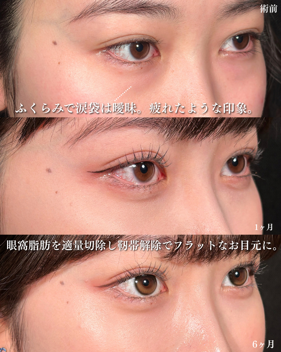 横浜院で行ったクマ取りの名医の吉田利之医師の切らないクマ取りの6ヶ月後までのダウンタイム症例写真
