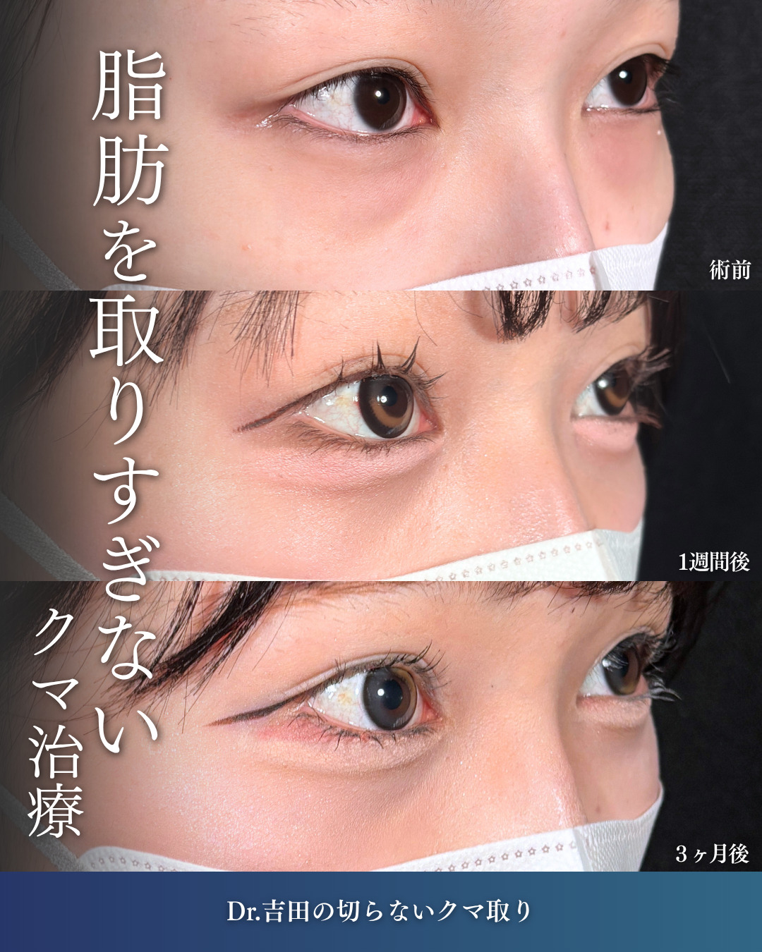 横浜院で行ったクマ取りの名医の吉田利之医師の切らないクマ取りの3ヶ月後までのダウンタイム症例写真
