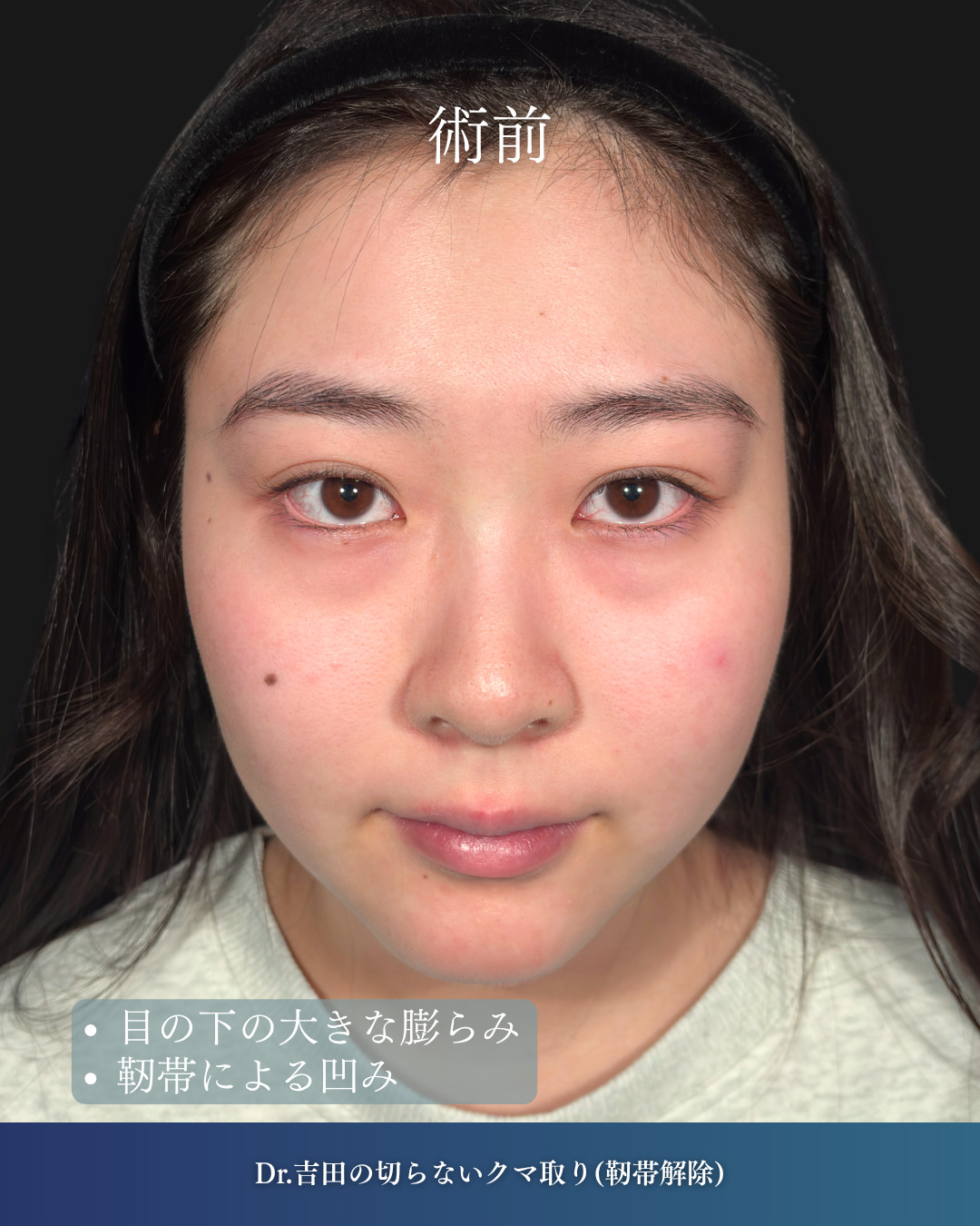 横浜院で行ったクマ取りの名医の吉田利之医師の切らないクマ取りの6ヶ月後までのダウンタイム症例写真
