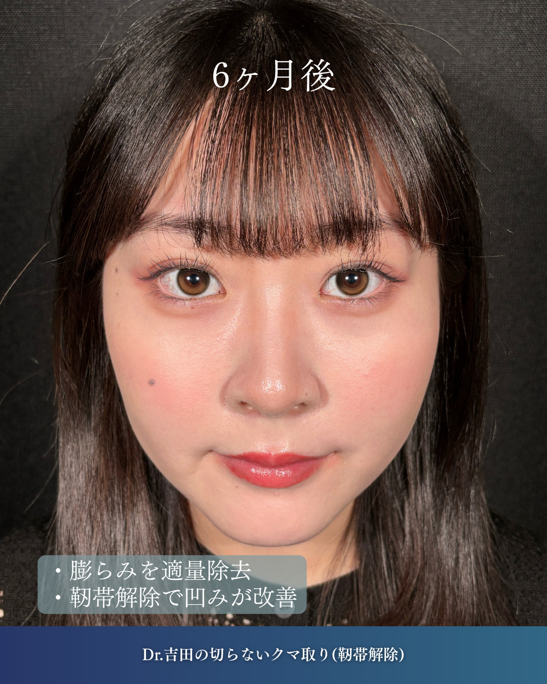 横浜院で行ったクマ取りの名医の吉田利之医師の切らないクマ取りの6ヶ月後までのダウンタイム症例写真