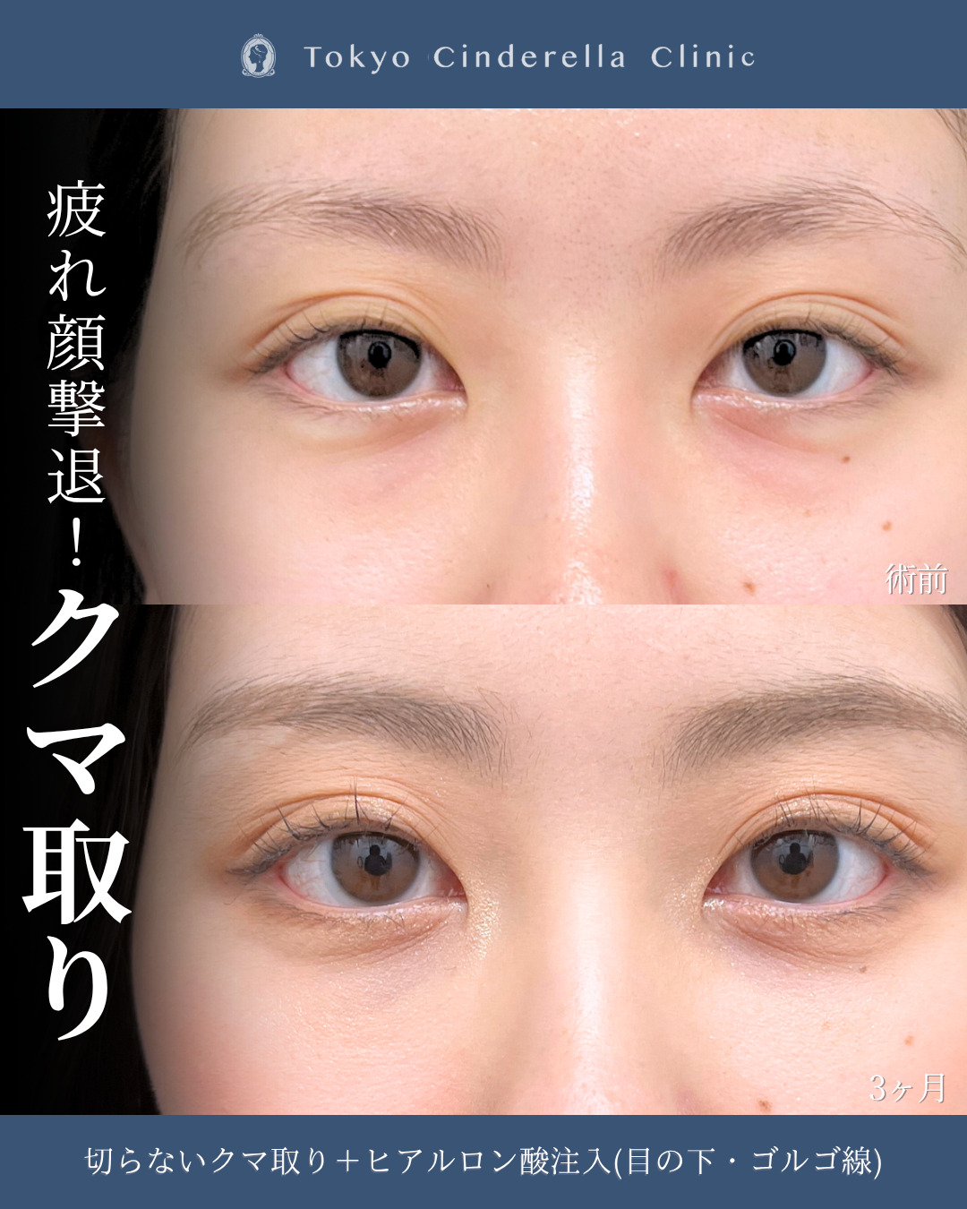 新宿院院長吉原伯執刀、切らないクマ取りとヒアルロン酸注入の３ヶ月比較