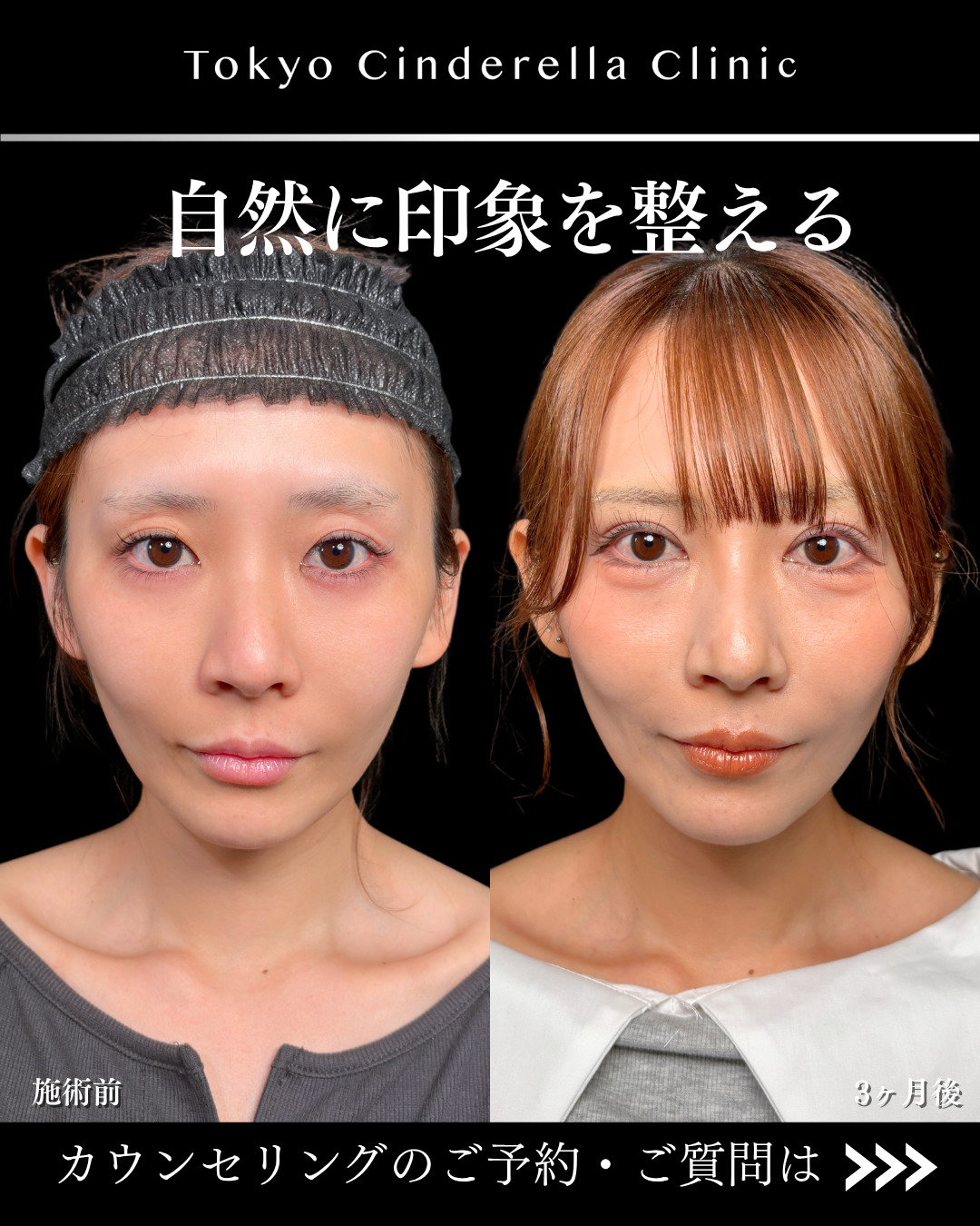 大宮院で行った二重埋没と目頭切開で有名な名医の竹田昌平医師の症例写真
