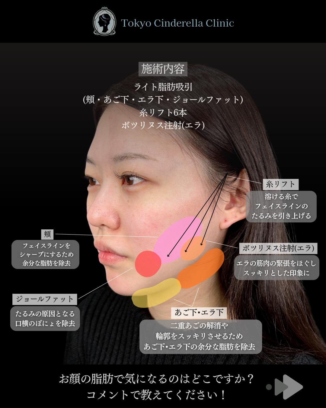 池袋院で行ったライト脂肪吸引(頬・あご下・エラ下・ジョールファット)と糸リフト6本とボツリヌス注射(エラ)整形の名医の石井達也医師の症例写真