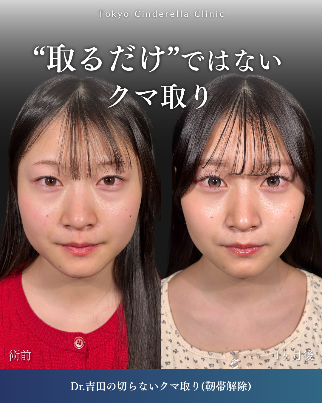 横浜院で行ったクマ取りの名医の吉田利之医師の切らないクマ取り(靭帯解除)の1ヶ月後の症例写真