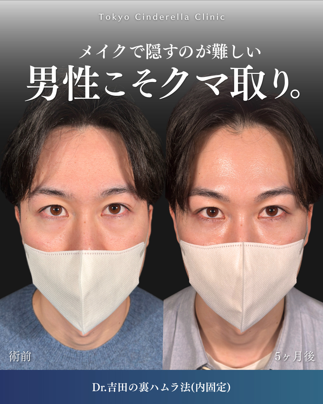横浜院で行ったクマ取りの名医の吉田利之医師の裏ハムラ法の5ヶ月後までのダウンタイム症例写真