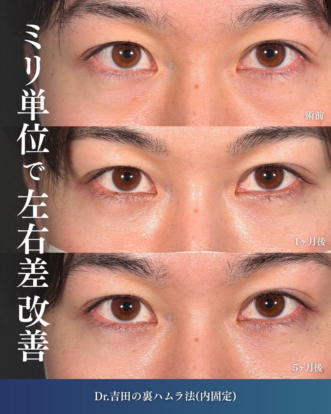 横浜院で行ったクマ取りの名医の吉田利之医師の裏ハムラ法の5ヶ月後までのダウンタイム症例写真