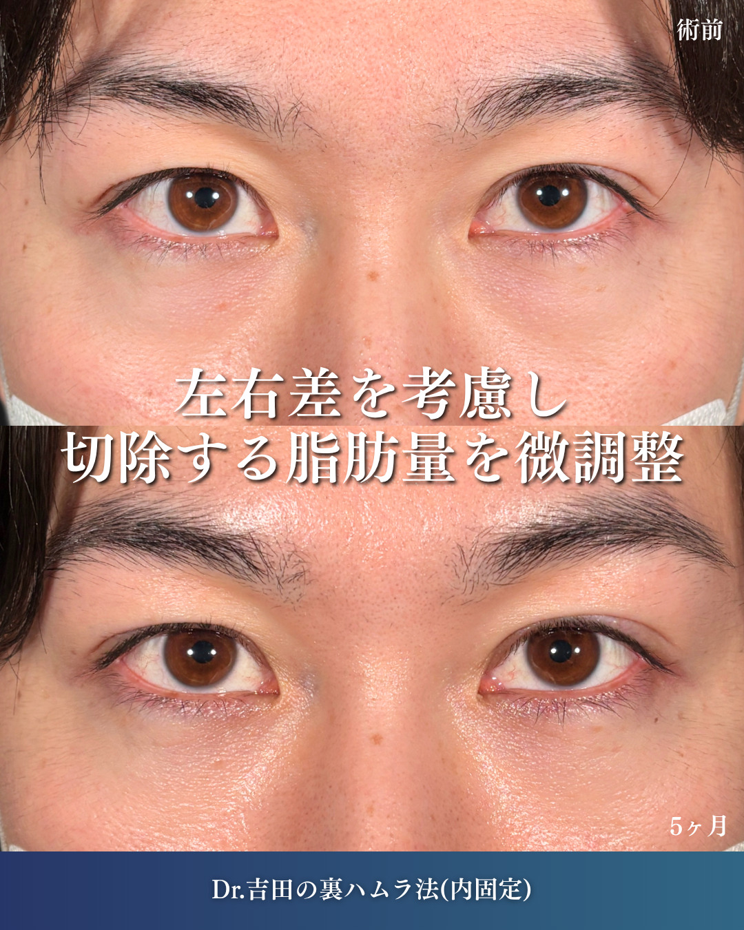 横浜院で行ったクマ取りの名医の吉田利之医師の裏ハムラ法の5ヶ月後までのダウンタイム症例写真