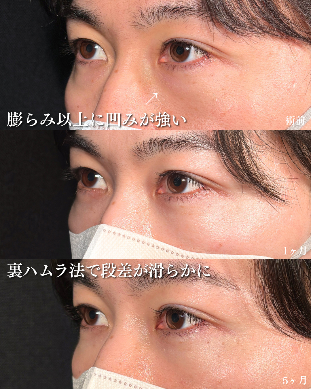 横浜院で行ったクマ取りの名医の吉田利之医師の裏ハムラ法の5ヶ月後までのダウンタイム症例写真