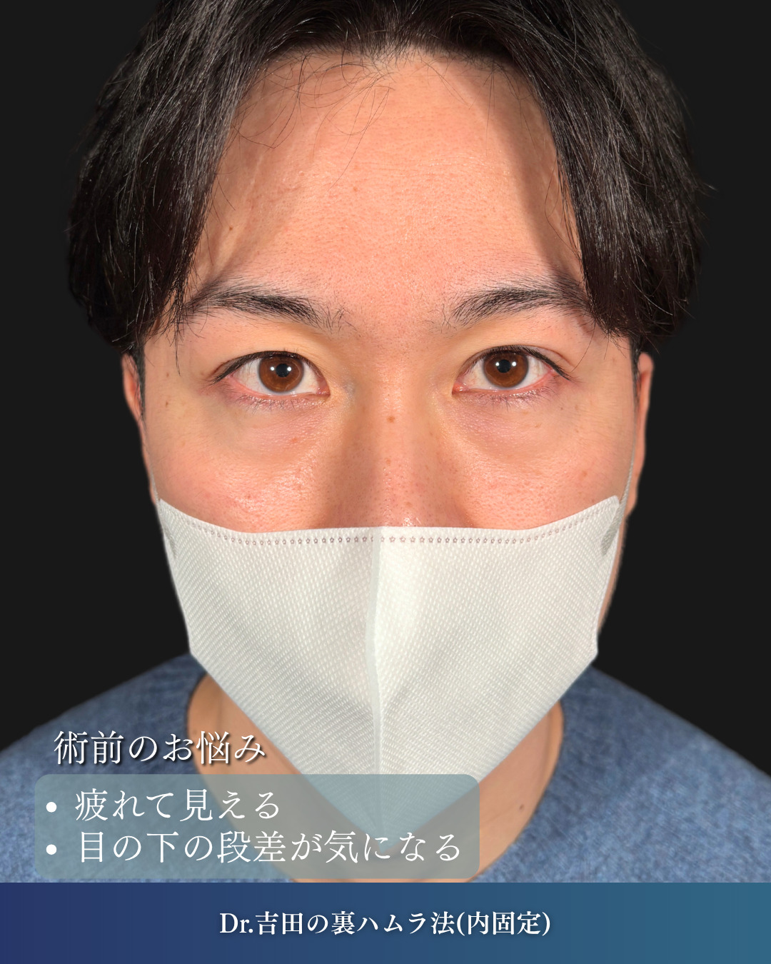 横浜院で行ったクマ取りの名医の吉田利之医師の裏ハムラ法の5ヶ月後までのダウンタイム症例写真