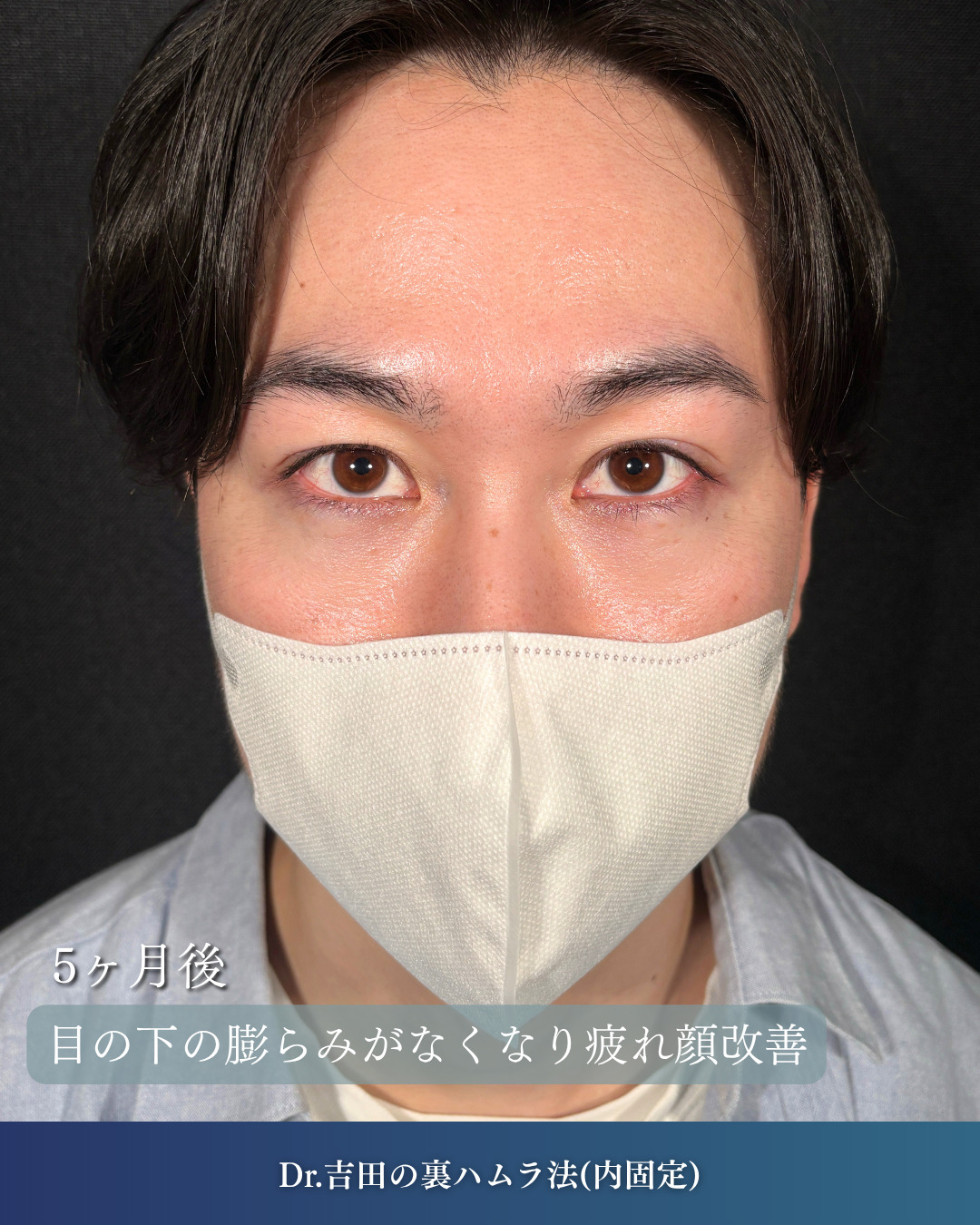 横浜院で行ったクマ取りの名医の吉田利之医師の裏ハムラ法の5ヶ月後までのダウンタイム症例写真