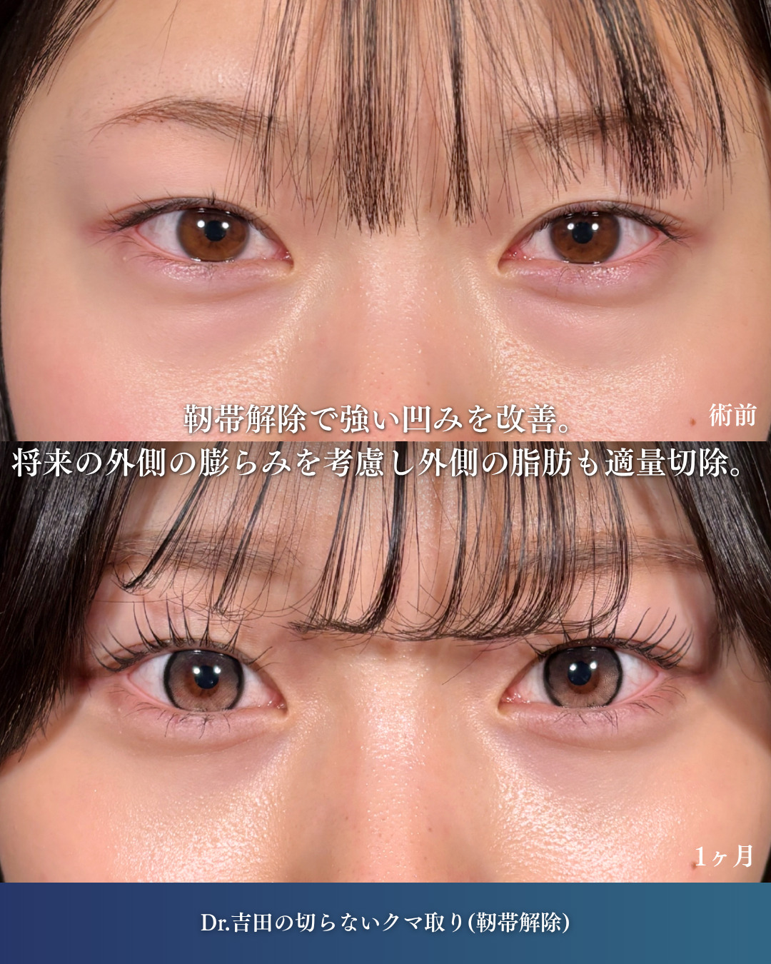 横浜院で行ったクマ取りの名医の吉田利之医師の切らないクマ取り(靭帯解除)の1ヶ月後の症例写真