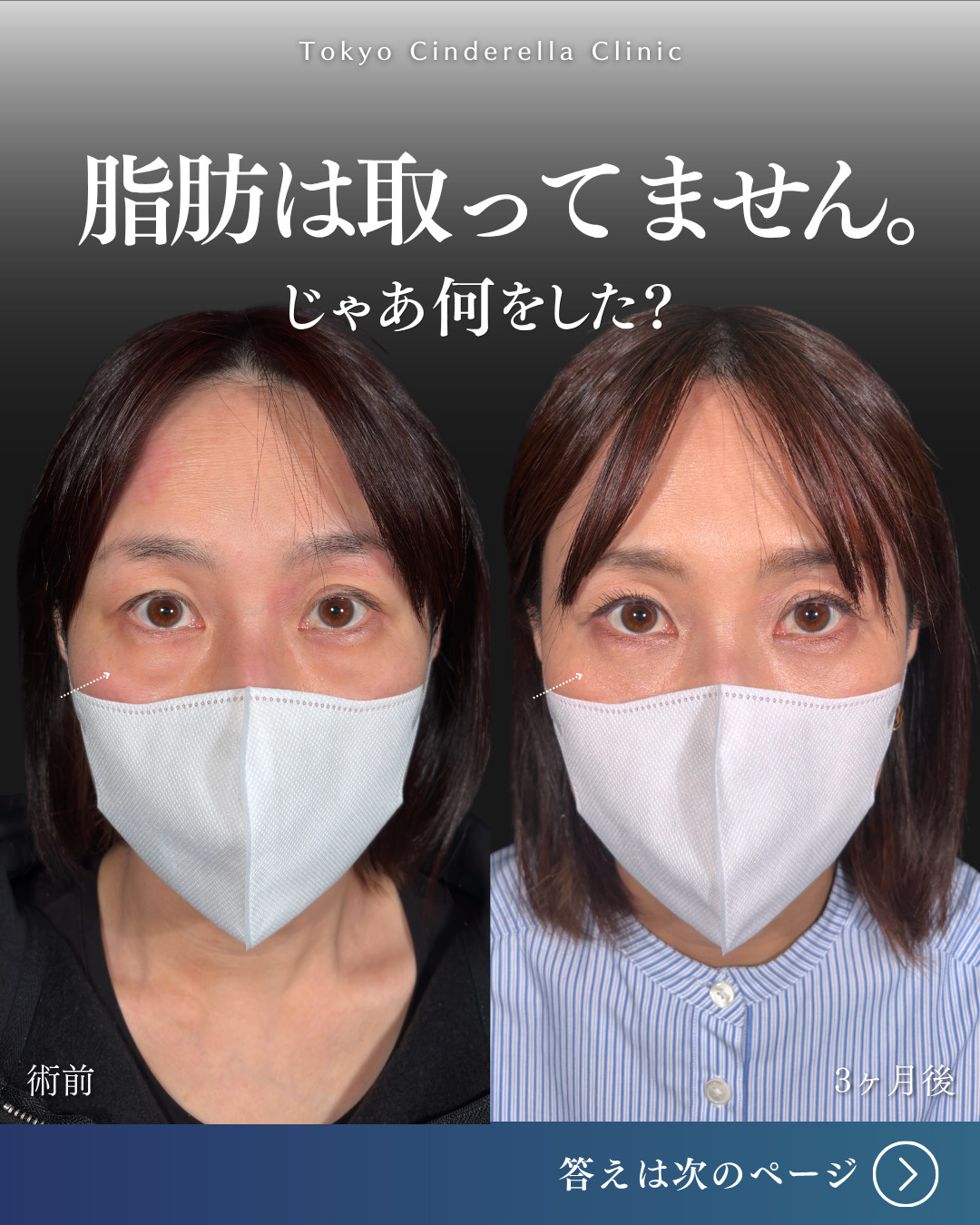 横浜院で行ったクマ取りの名医の吉田利之医師のMD式裏ハムラ法の3ヶ月後までのダウンタイム症例写真