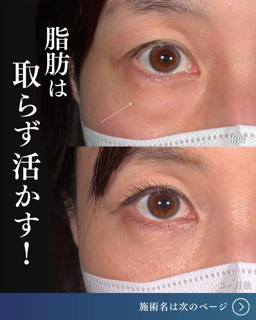 横浜院で行ったクマ取りの名医の吉田利之医師のMD式裏ハムラ法の3ヶ月後までのダウンタイム症例写真