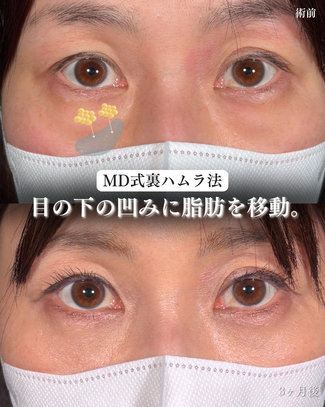 横浜院で行ったクマ取りの名医の吉田利之医師のMD式裏ハムラ法の3ヶ月後までのダウンタイム症例写真