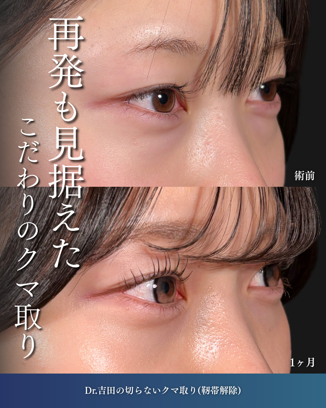 横浜院で行ったクマ取りの名医の吉田利之医師の切らないクマ取り(靭帯解除)の1ヶ月後の症例写真
