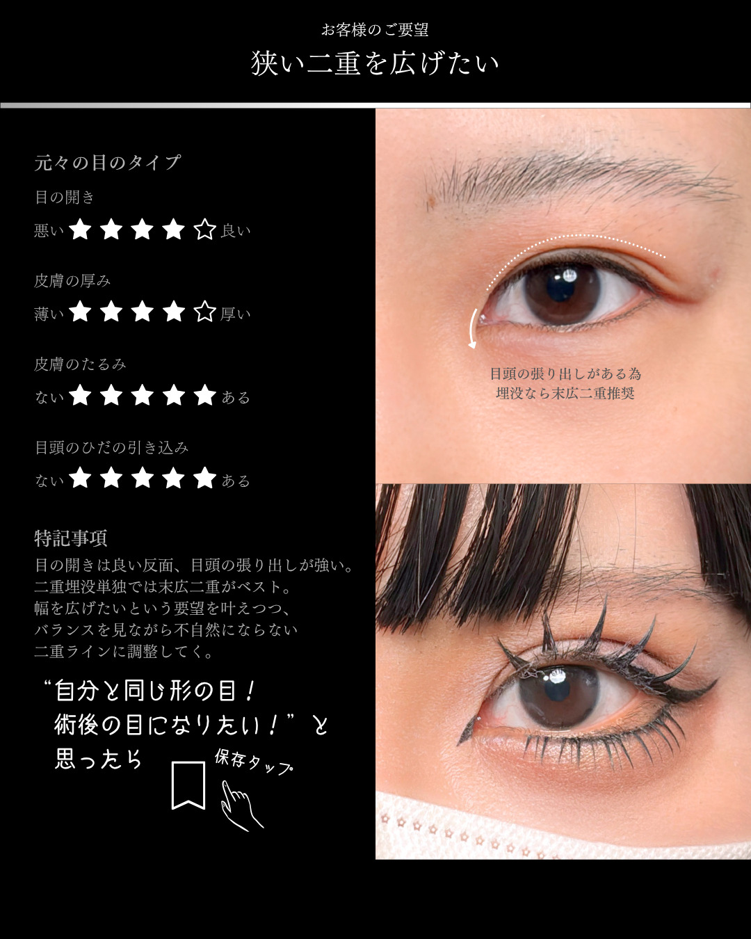派手メイク負けしない二重 」に関する美容整形の症例写真の詳細 | 新宿